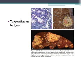 • Үсэрхийлсэн
байдал
 