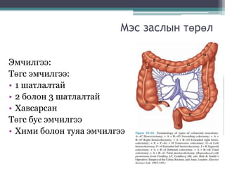 Мэс заслын төрөл
Эмчилгээ:
Төгс эмчилгээ:
• 1 шатлалтай
• 2 болон 3 шатлалтай
• Хавсарсан
Төгс бус эмчилгээ
• Хими болон туяа эмчилгээ
 