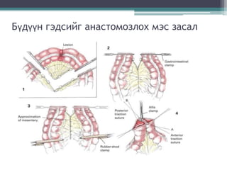 Бүдүүн гэдсийг анастомозлох мэс засал
 
