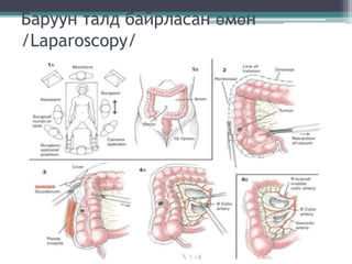 Баруун талд байрласан өмөн
/Laparoscopy/
 
