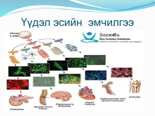 Үүдэл эсийн эмчилгээ
 