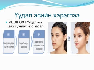 Үүдэл эсийн хэрэглээ
 MEDIPOST Үүдэл эст
өөх суулгах мэс засал
 
