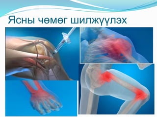 Ясны чөмөг шилжүүлэх
 