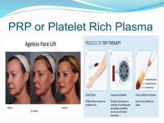 PRP or Platelet Rich Plasma
 