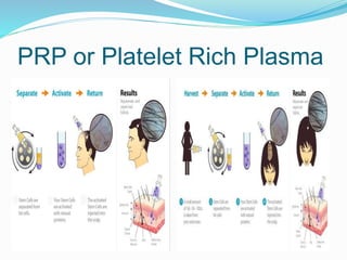 PRP or Platelet Rich Plasma
 