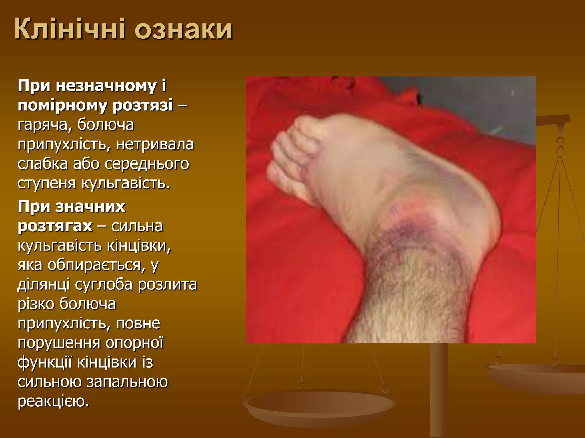 Клінічні ознаки
При незначному і
помірному розтязі –
гаряча, болюча
припухлість, нетривала
слабка або середнього
ступеня кульгавість.
При значних
розтягах – сильна
кульгавість кінцівки,
яка обпирається, у
ділянці суглоба розлита
різко болюча
припухлість, повне
порушення опорної
функції кінцівки із
сильною запальною
реакцією.
 