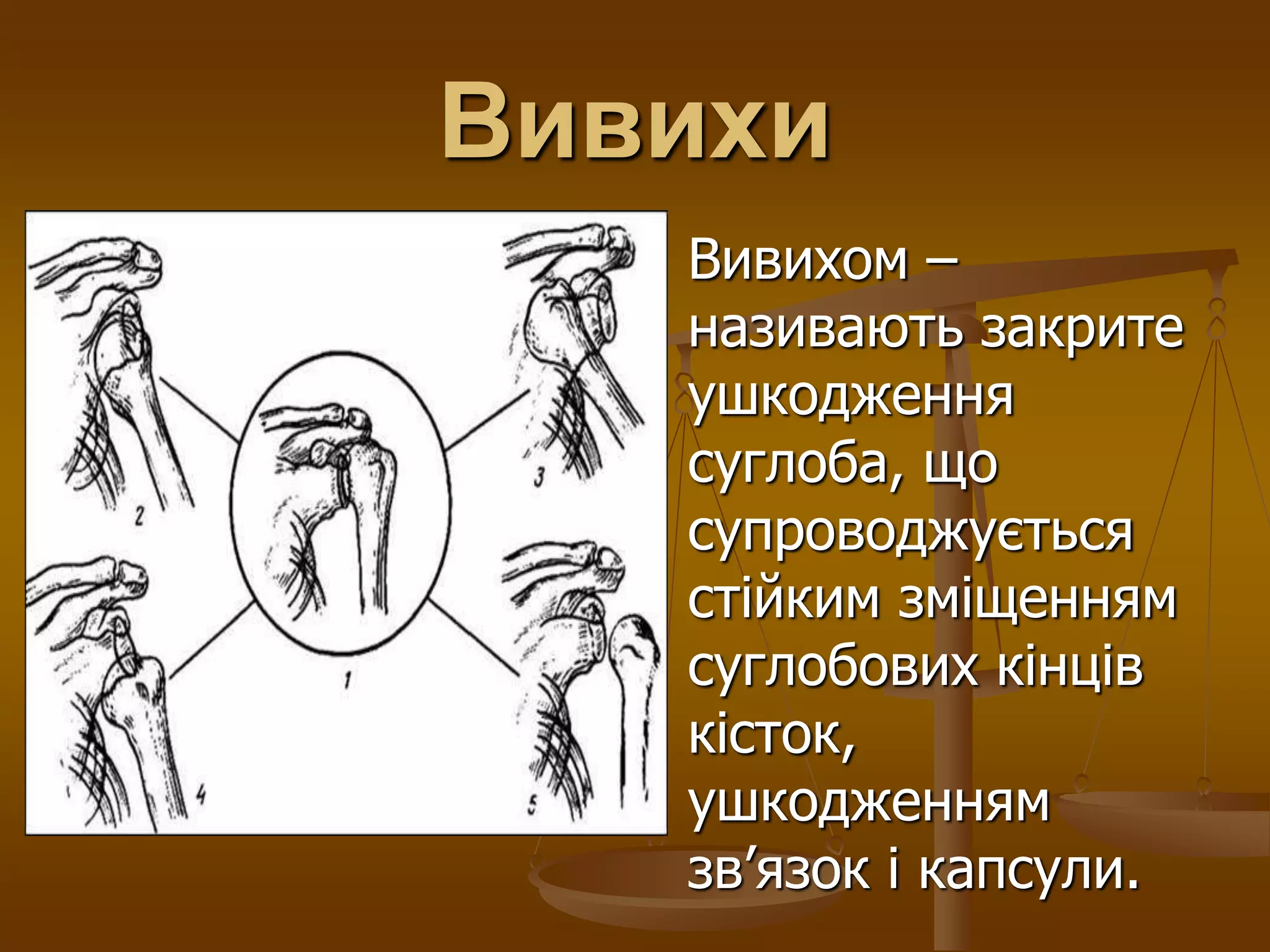 Вивихи
Вивихом –
називають закрите
ушкодження
суглоба, що
супроводжується
стійким зміщенням
суглобових кінців
кісток,
ушкодженням
зв’язок і капсули.
 