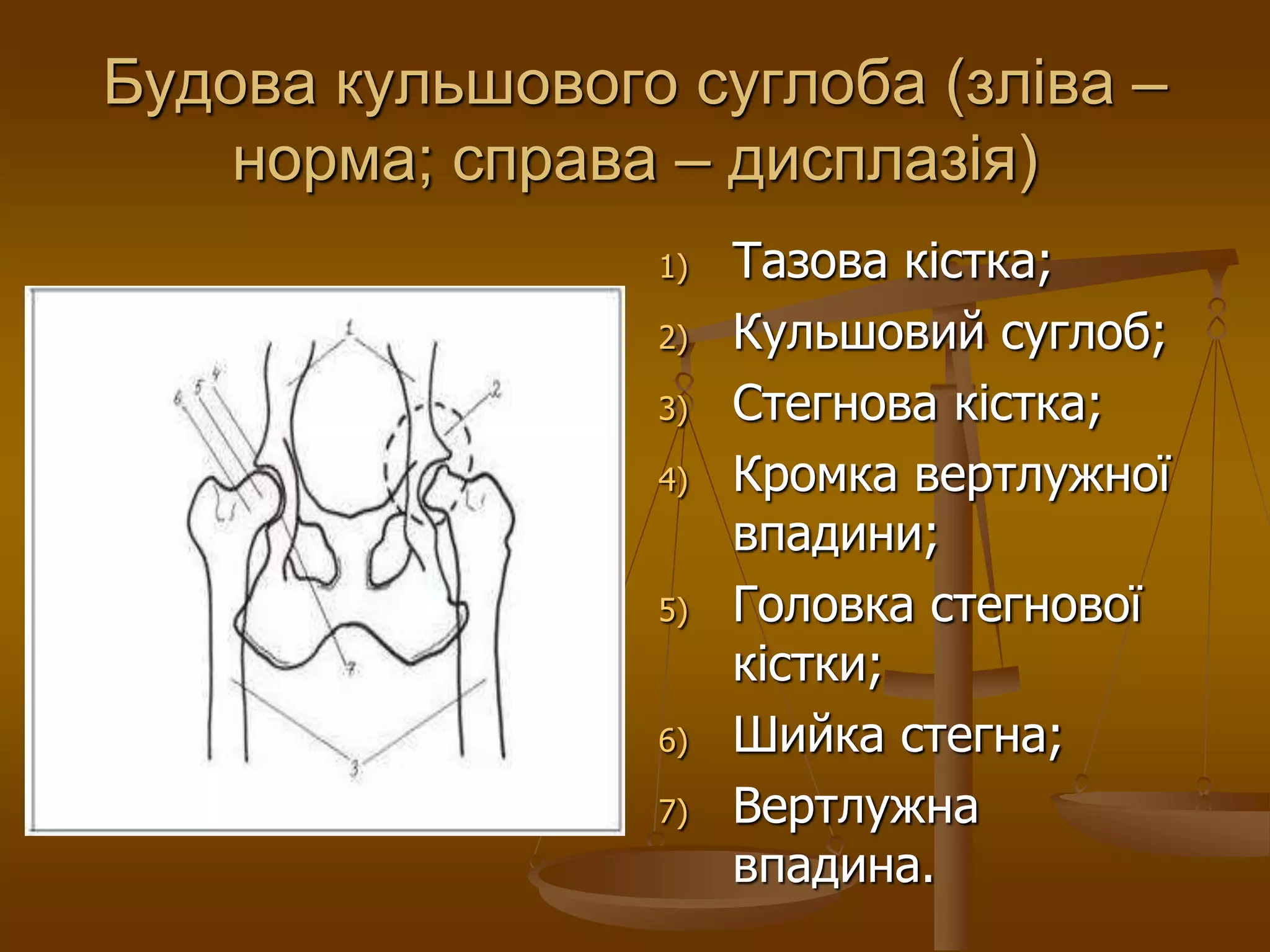 Будова кульшового суглоба (зліва –
норма; справа – дисплазія)
1) Тазова кістка;
2) Кульшовий суглоб;
3) Стегнова кістка;
4) Кромка вертлужної
впадини;
5) Головка стегнової
кістки;
6) Шийка стегна;
7) Вертлужна
впадина.
 