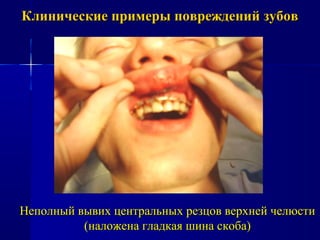 Клинические примеры повреждений зубовКлинические примеры повреждений зубов
Неполный вывих центральных резцов верхней челюстиНеполный вывих центральных резцов верхней челюсти
(наложена гладкая шина скоба)(наложена гладкая шина скоба)
 