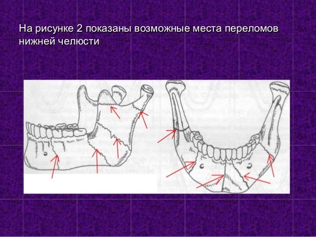 Нижняя челюсть схема. Перелом челюсти признаки и оказание. Как осуществляется питание при переломе челюсти.