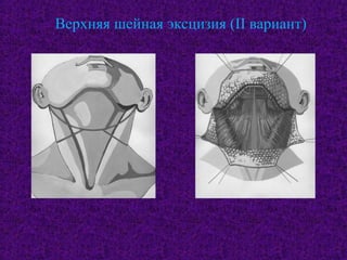 Верхняя шейная эксцизия (II вариант)
 