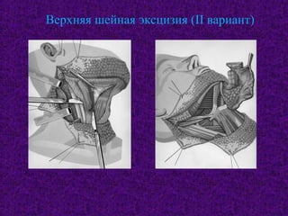 Верхняя шейная эксцизия (II вариант)
 