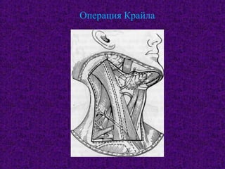 Операция Крайла
 