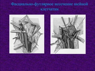 Фасциально-футлярное иссечение шейной
клетчатки
 