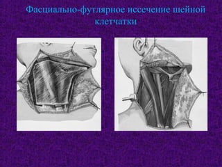 Фасциально-футлярное иссечение шейной
клетчатки
 