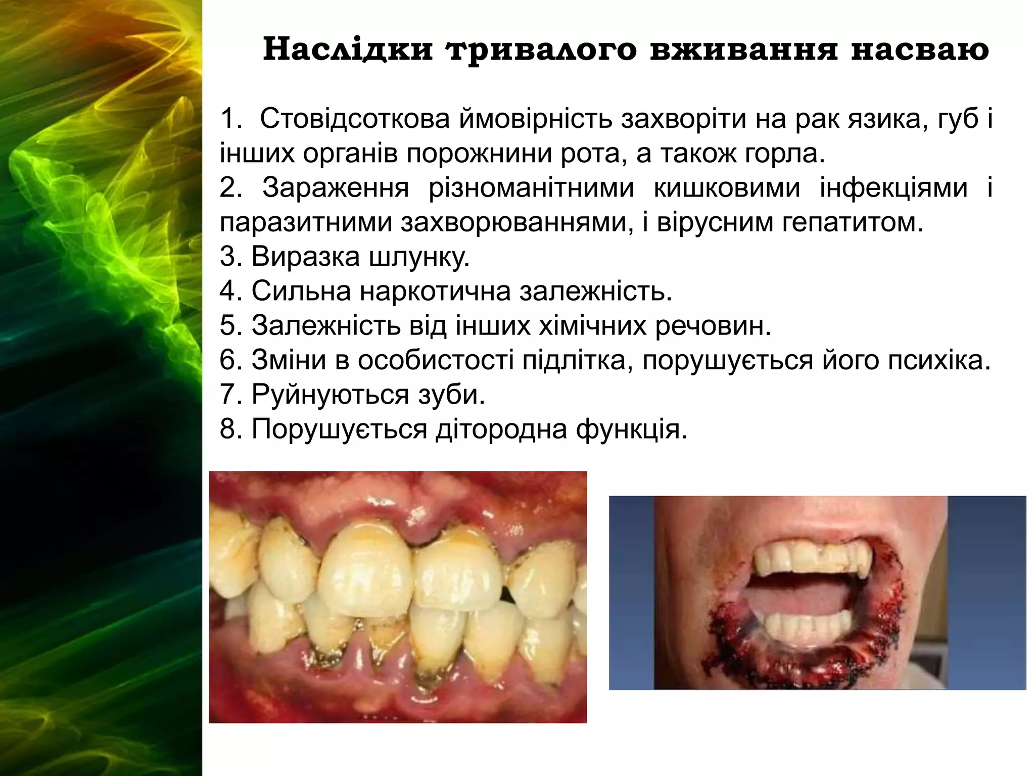 Наслідки тривалого вживання насваю
1. Стовідсоткова ймовірність захворіти на рак язика, губ і
інших органів порожнини рота, а також горла.
2. Зараження різноманітними кишковими інфекціями і
паразитними захворюваннями, і вірусним гепатитом.
3. Виразка шлунку.
4. Сильна наркотична залежність.
5. Залежність від інших хімічних речовин.
6. Зміни в особистості підлітка, порушується його психіка.
7. Руйнуються зуби.
8. Порушується дітородна функція..
 