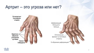 Артрит – это угроза или нет?
 