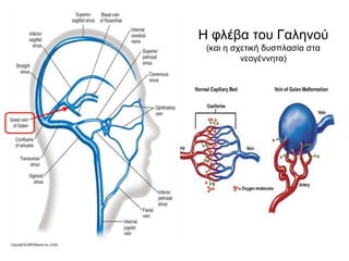 Η φλέβα του Γαληνού
(και η σχετική δυσπλασία στα
νεογέννητα)
 
