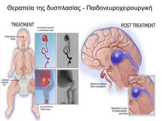 Θεραπεία της δυσπλασίας - Παιδονευροχειρουργική
 