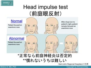 Shikino K, MD, PhD Copyright by Shinsenichiba
Head impulse test
（前庭眼反射）
Abnormal
Normal
*正常なら前庭神経炎は否定的
**慣れないうちは難しい
Saint John Regional Hospitalより引用
 