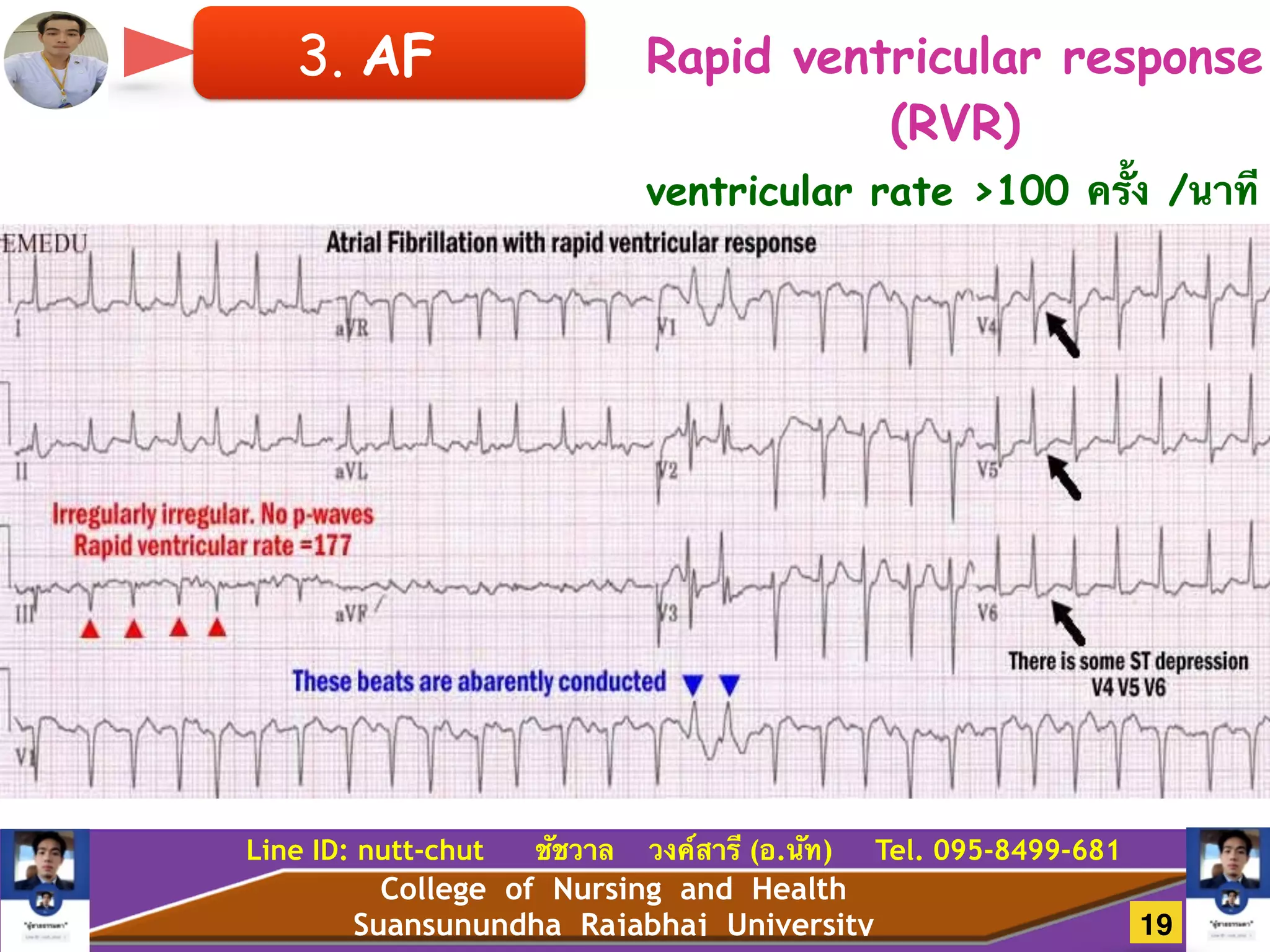College of Nursing and Health
Suansunundha Rajabhaj University
Line ID: nutt-chut ชัชวาล วงค์สารี (อ.นัท) Tel. 095-8499-681
3. AF
ventricular rate >100 ครั้ง /นาที
Rapid ventricular response
(RVR)
19
 