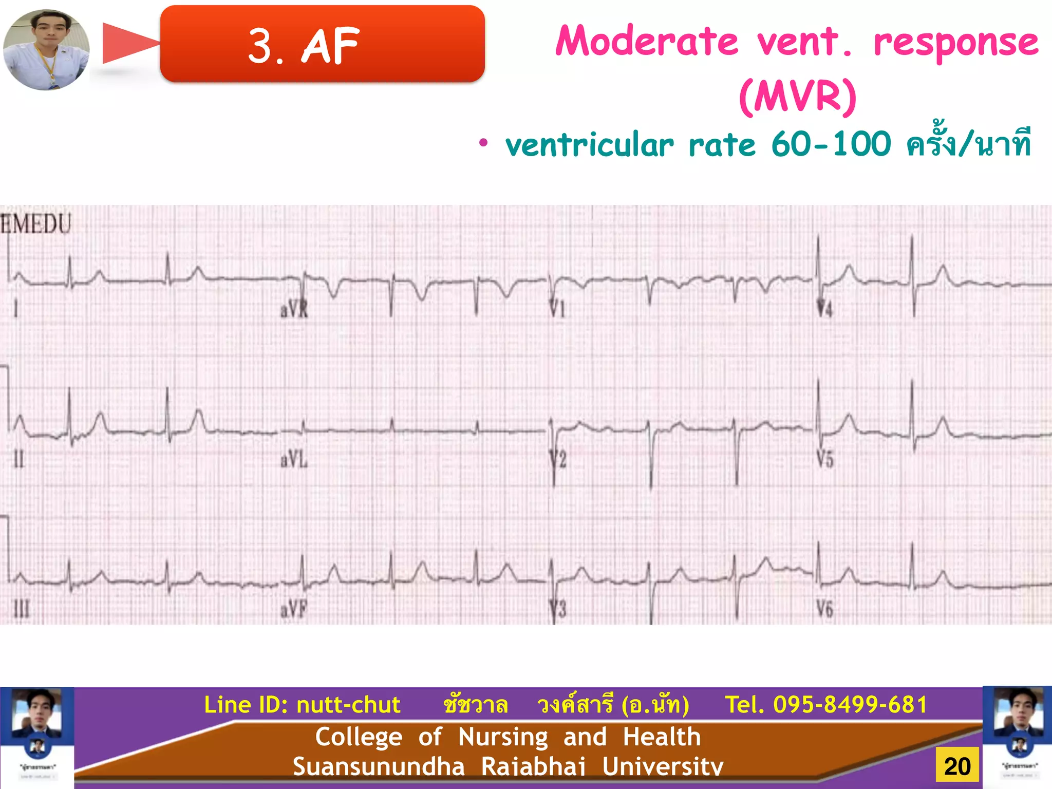 College of Nursing and Health
Suansunundha Rajabhaj University
Line ID: nutt-chut ชัชวาล วงค์สารี (อ.นัท) Tel. 095-8499-681
3. AF Moderate vent. response
(MVR)
• ventricular rate 60-100 ครั้ง/นาที
20
 