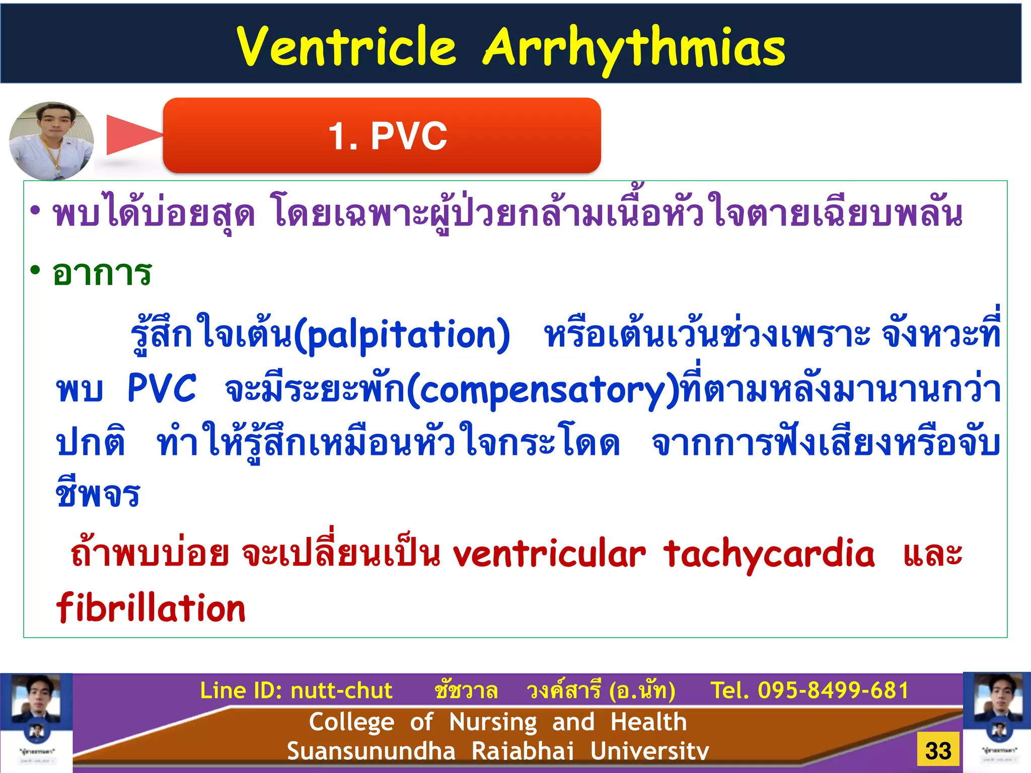 College of Nursing and Health
Suansunundha Rajabhaj University
Line ID: nutt-chut ชัชวาล วงค์สารี (อ.นัท) Tel. 095-8499-681
Ventricle Arrhythmias
1. PVC
• พบได้บ่อยสุด โดยเฉพาะผู้ป่วยกล้ามเนื้อหัวใจตายเฉียบพลัน!
• อาการ
รู้สึกใจเต้น(palpitation) หรือเต้นเว้นช่วงเพราะ จังหวะที่
พบ PVC จะมีระยะพัก(compensatory)ที่ตามหลังมานานกว่า
ปกติ ทำให้รู้สึกเหมือนหัวใจกระโดด จากการฟังเสียงหรือจับ
ชีพจร!
ถ้าพบบ่อย จะเปลี่ยนเป็น ventricular tachycardia และ
fibrillation
33
 