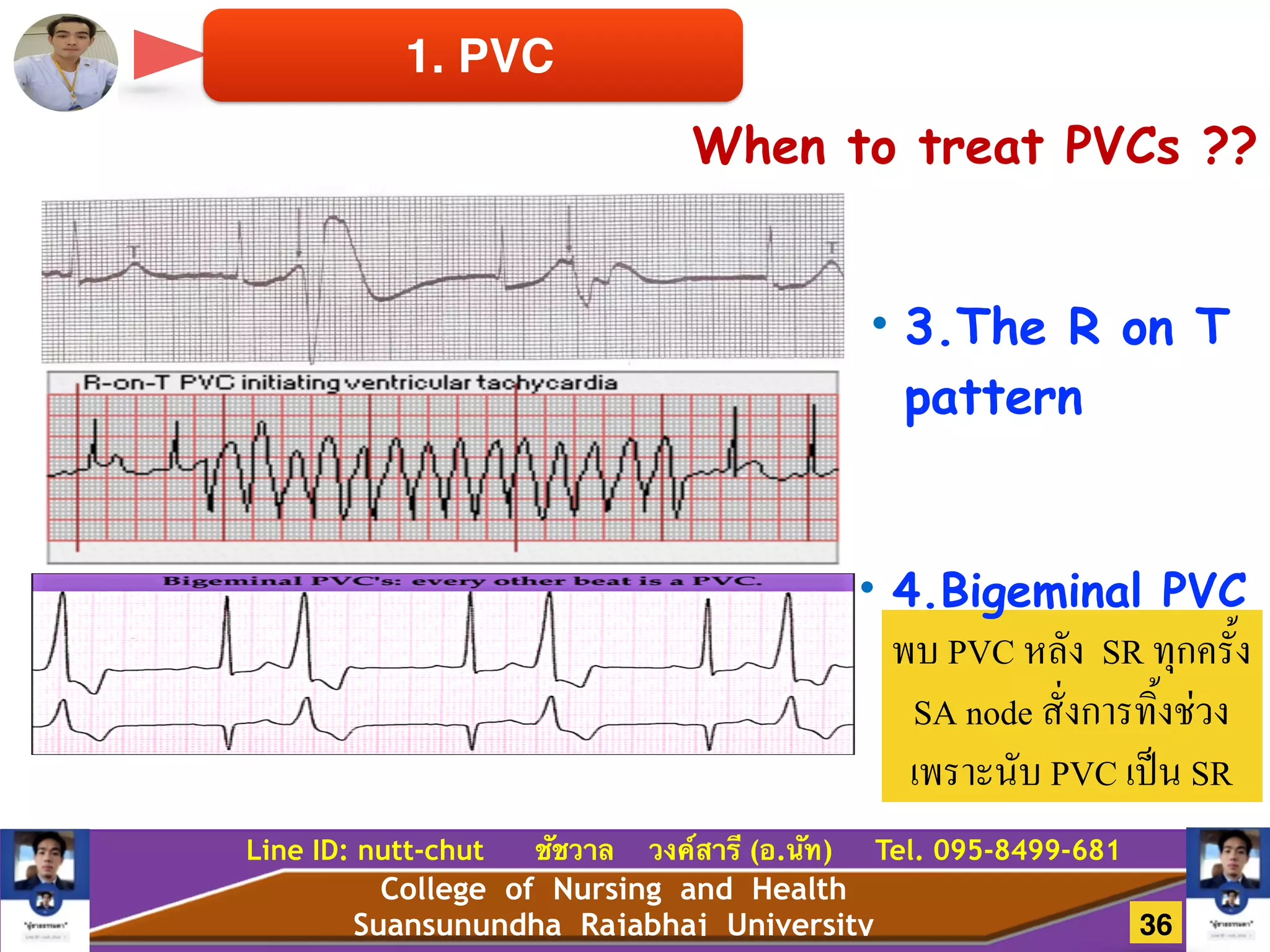 College of Nursing and Health
Suansunundha Rajabhaj University
Line ID: nutt-chut ชัชวาล วงค์สารี (อ.นัท) Tel. 095-8499-681
1. PVC
When to treat PVCs ??
• 3.The R on T
pattern
พบ PVC หลัง SR ทุกครั้ง
SA node สั่งการทิ้งช่วง
เพราะนับ PVC เป็น SR
• 4.Bigeminal PVC
36
 