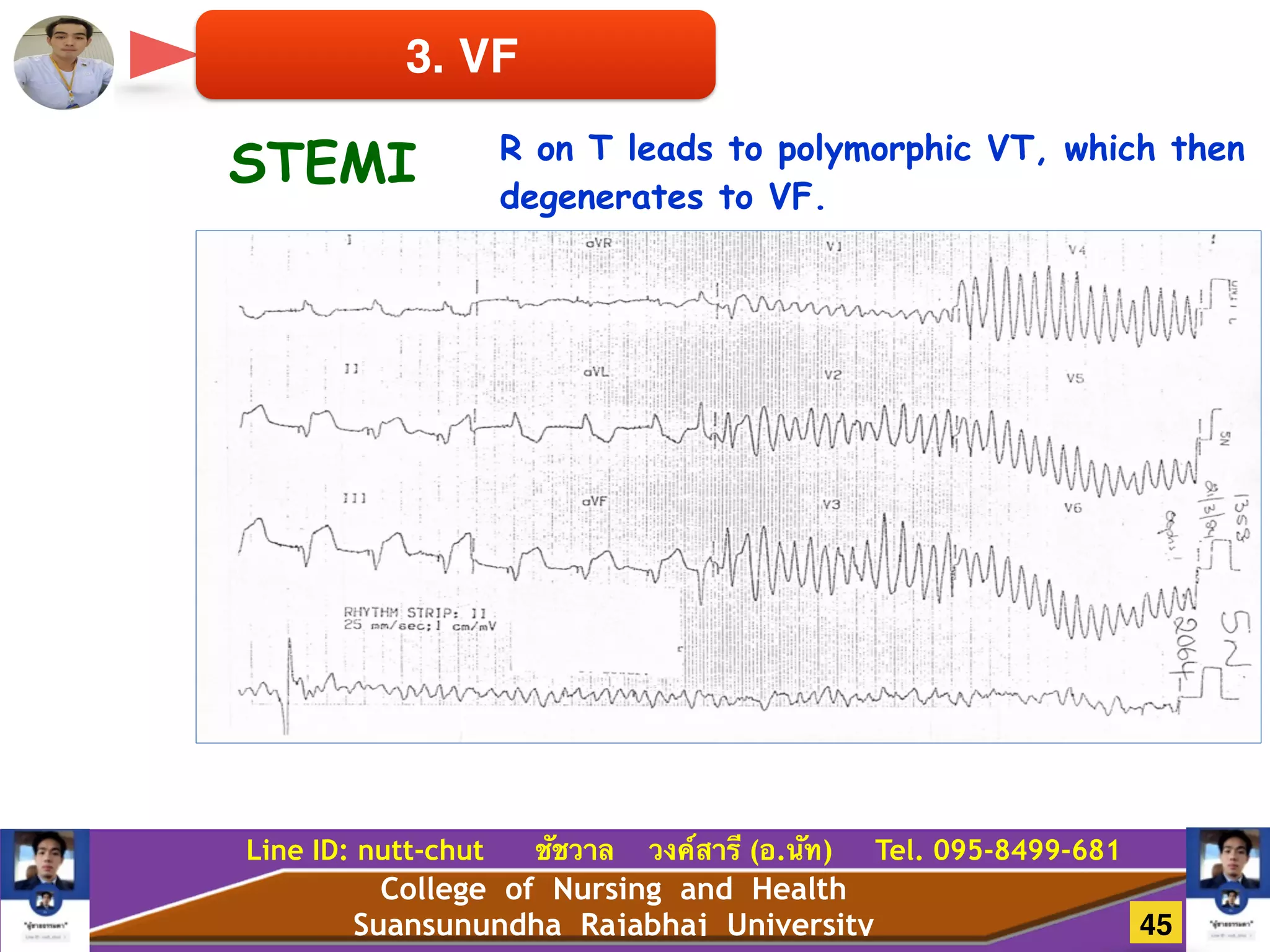 College of Nursing and Health
Suansunundha Rajabhaj University
Line ID: nutt-chut ชัชวาล วงค์สารี (อ.นัท) Tel. 095-8499-681
3. VF
STEMI R on T leads to polymorphic VT, which then
degenerates to VF.
45
 