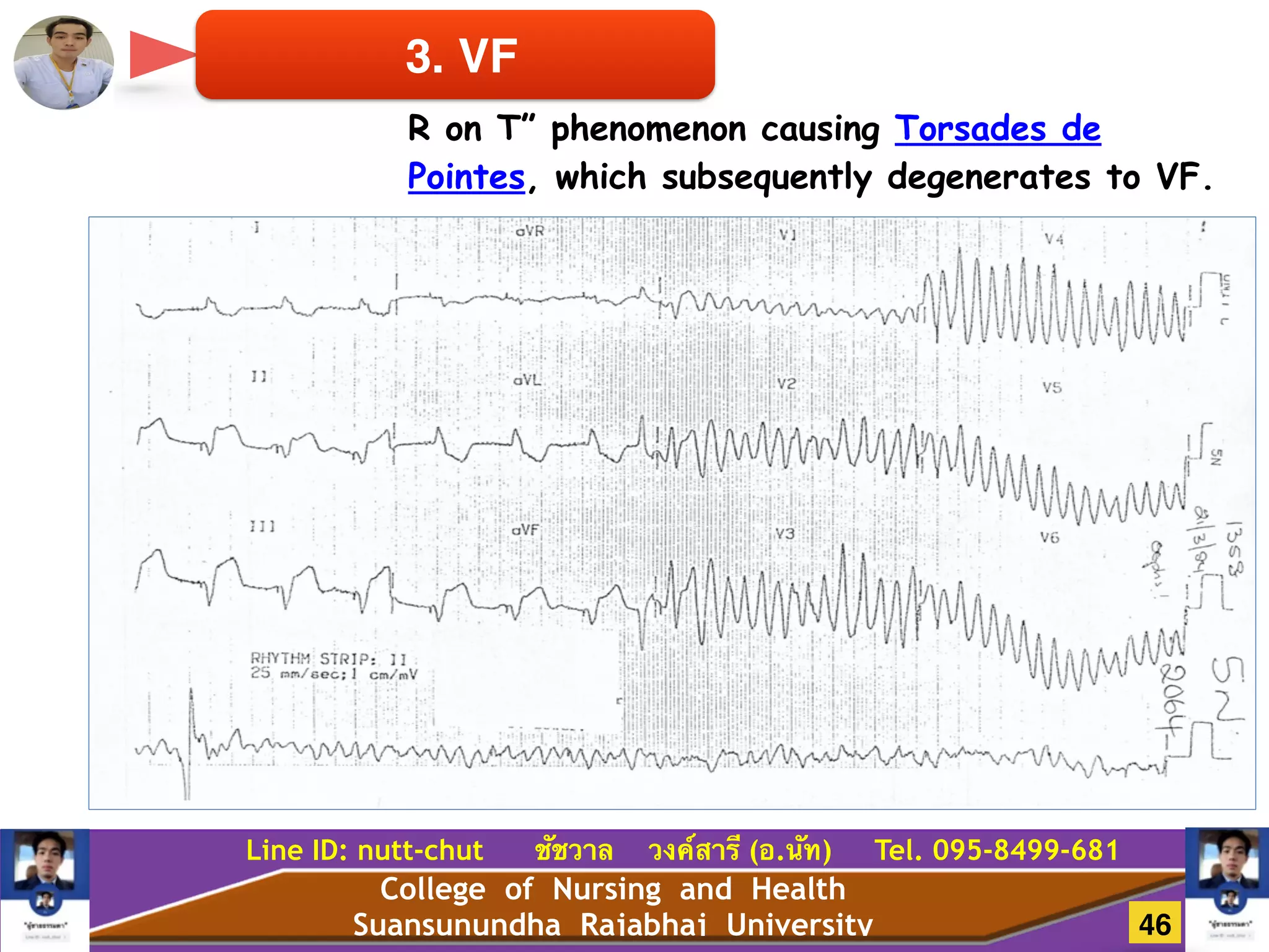 College of Nursing and Health
Suansunundha Rajabhaj University
Line ID: nutt-chut ชัชวาล วงค์สารี (อ.นัท) Tel. 095-8499-681
3. VF
R on T” phenomenon causing Torsades de
Pointes, which subsequently degenerates to VF.
46
 