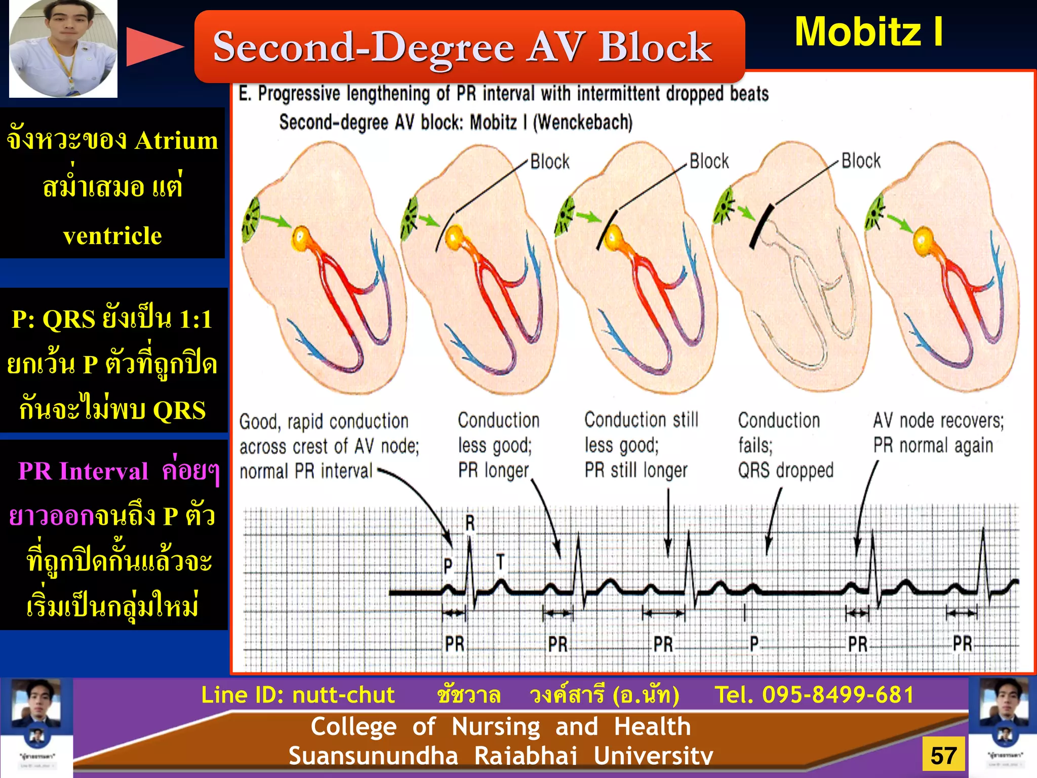 College of Nursing and Health
Suansunundha Rajabhaj University
Line ID: nutt-chut ชัชวาล วงค์สารี (อ.นัท) Tel. 095-8499-681
Second-Degree AV Block Mobitz I
จังหวะของ Atrium
สม่ำเสมอ เเต่
ventricle
P: QRS ยังเป็น 1:1
ยกเว้น P ตัวที่ถูกปิด
กันจะไม่พบ QRS
PR Interval ค่อยๆ
ยาวออกจนถึง P ตัว
ที่ถูกปิดกั้นเเล้วจะ
เริ่มเป็นกลุ่มใหม่
57
 