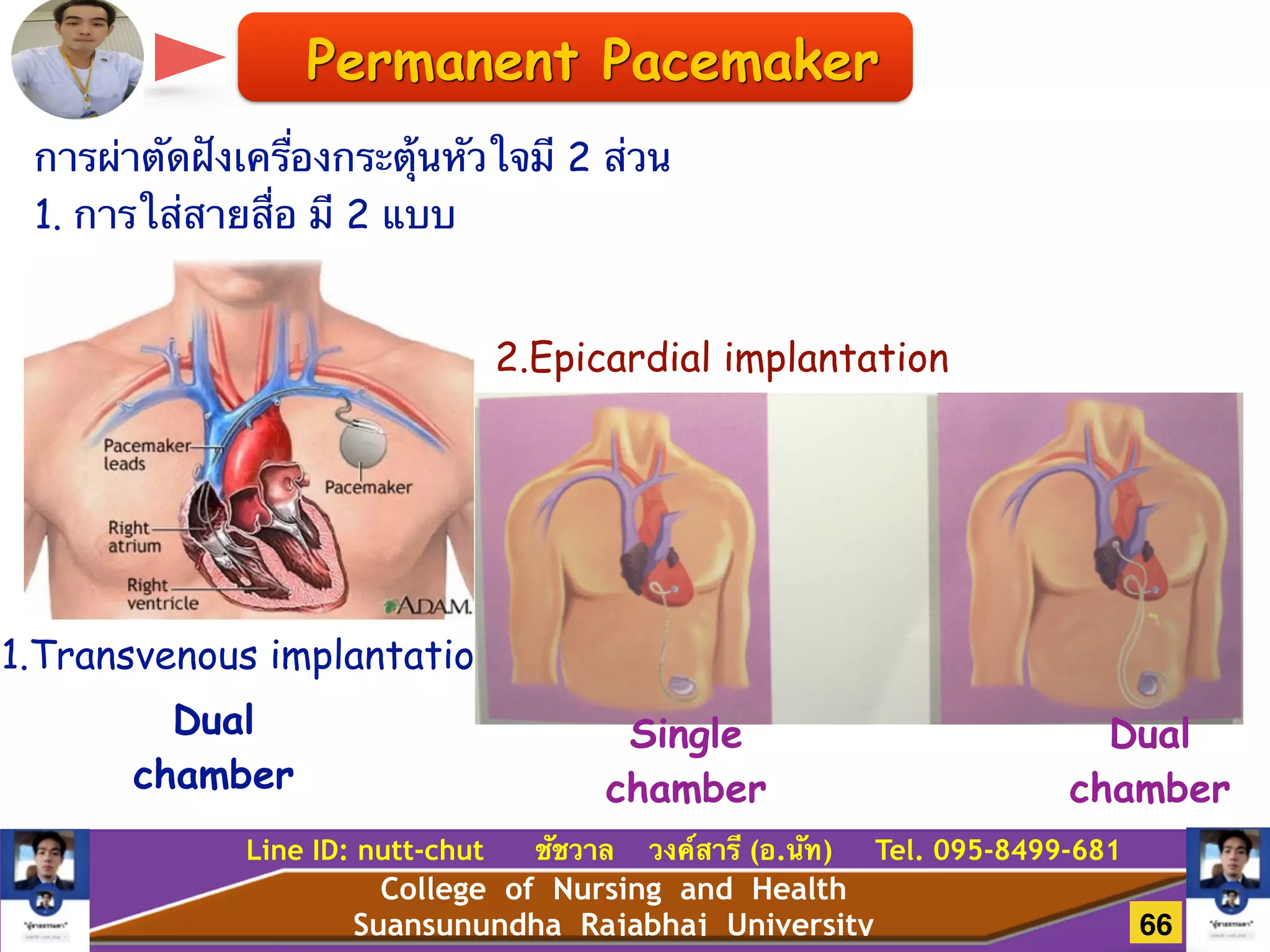College of Nursing and Health
Suansunundha Rajabhaj University
Line ID: nutt-chut ชัชวาล วงค์สารี (อ.นัท) Tel. 095-8499-681
การผ่าตัดฝังเครื่องกระตุ้นหัวใจมี 2 ส่วน
1. การใส่สายสื่อ มี 2 แบบ
Dual
chamber
1.Transvenous implantation
2.Epicardial implantation
Single
chamber
Dual
chamber
Permanent Pacemaker
66
 