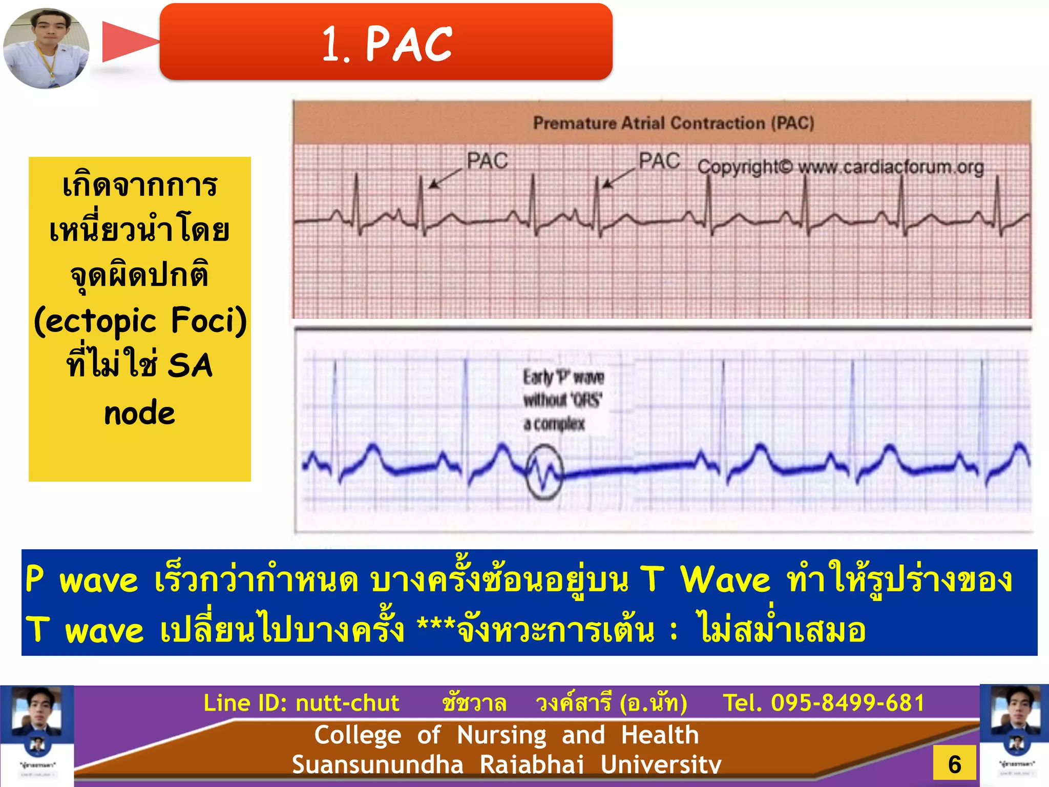 College of Nursing and Health
Suansunundha Rajabhaj University
Line ID: nutt-chut ชัชวาล วงค์สารี (อ.นัท) Tel. 095-8499-681
1. PAC
เกิดจากการ
เหนี่ยวนำโดย
จุดผิดปกติ
(ectopic Foci)
ที่ไม่ใช่ SA
node
P wave เร็วกว่ากำหนด บางครั้งซ้อนอยู่บน T Wave ทำให้รูปร่างของ
T wave เปลี่ยนไปบางครั้ง ***จังหวะการเต้น : ไม่สม่ำเสมอ
6
 
