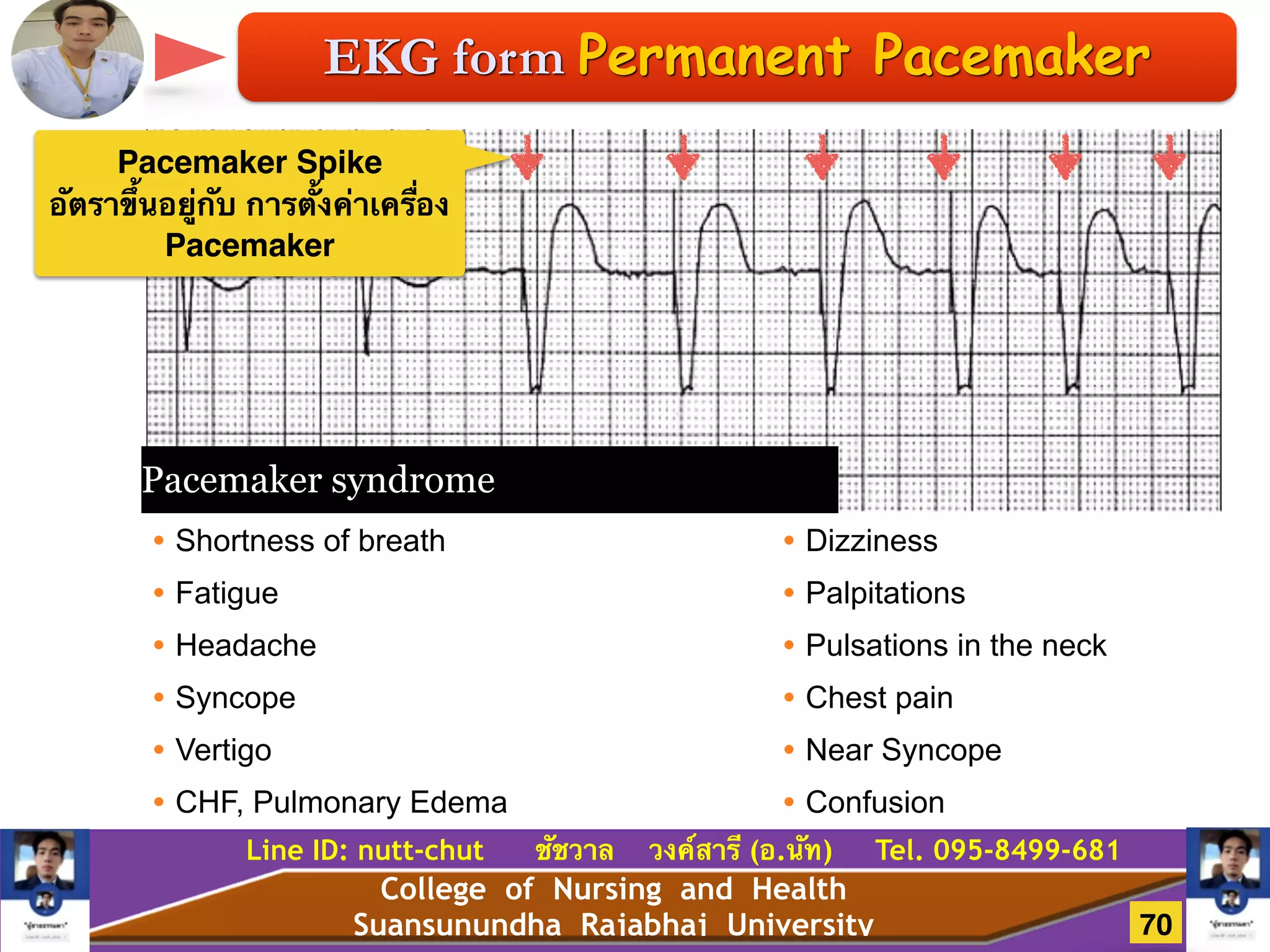 College of Nursing and Health
Suansunundha Rajabhaj University
Line ID: nutt-chut ชัชวาล วงค์สารี (อ.นัท) Tel. 095-8499-681
EKG form Permanent Pacemaker
• Shortness of breath
• Fatigue
• Headache
• Syncope
• Vertigo
• CHF, Pulmonary Edema
Pacemaker syndrome
• Dizziness
• Palpitations
• Pulsations in the neck
• Chest pain
• Near Syncope
• Confusion
Pacemaker Spike!
อัตราขึ้นอยู่กับ การตั้งค่าเครื่อง
Pacemaker!
70
 