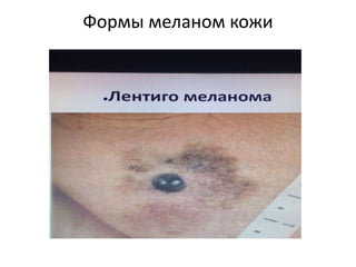 Формы меланом кожи
 