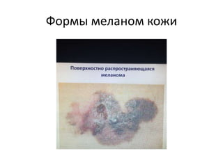Формы меланом кожи
 
