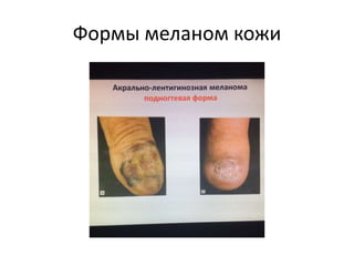 Формы меланом кожи
 