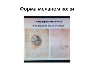 Форма меланом кожи
 