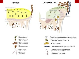 Хондроцит Гипертрофированный хондроцит
Остеобласт
Остеокласт
Синовиоцит
Остеоцит
Сосуды
Хондрокласт
НОРМА ОСТЕОАРТРИТ
Синовиальные фибробласты
Остеоцит, хондробласт
Инвазия сосудов
“Сжатые” остеобласты
 