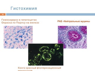 Гистохимия
24
Конго красный (поляризационный
Гемосидероз в гепатоцитах
Окраска по Перлсу на железо
PAS -Нейтральные муцины
 