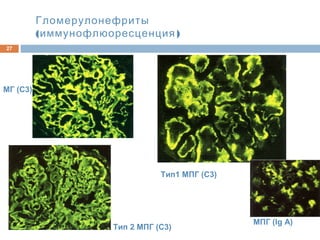 Гломерулонефриты
( )иммунофлюоресценция
27
Тип1 МПГ (С3)
МГ (С3)
Тип 2 МПГ (С3)
МПГ (Ig A)
 