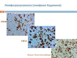 Лимфогрануломатоз (лимфома Ходжкина)
34
CD30
CD15
-Вирус Эпштейна Барр
 
