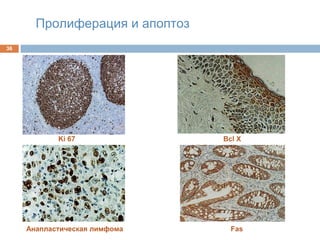 Пролиферация и апоптоз
36
Ki 67
Анапластическая лимфома
Bcl Х
Fas
 