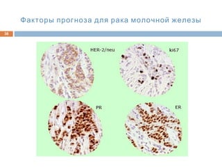 38
Факторы прогноза для рака молочной железы
 