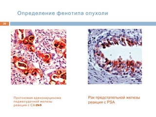 Определение фенотипа опухоли
39
Протоковая аденокарцинома
поджелудочной железы
19-9реакция с СА
Рак предстательной железы
реакция с PSA
 