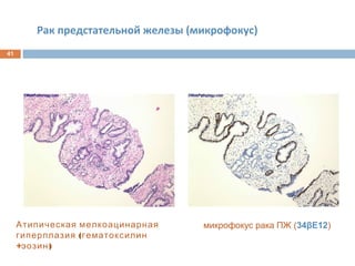 Рак предстательной железы (микрофокус)
41
Атипическая мелкоацинарная
(гиперплазия гематоксилин
+ )эозин
микрофокус рака ПЖ (34βE12)
 