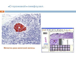 « »Сторожевой лимфоузел.
42
Метастаз рака молочной железы
 