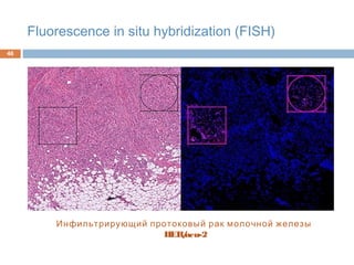 Fluorescence in situ hybridization (FISH)
46
Инфильтрирующий протоковый рак молочной железы
HER/neu-2
 