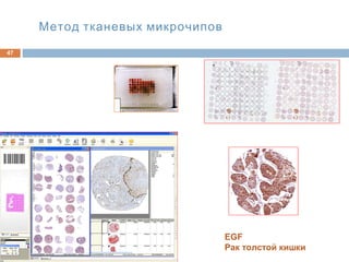 Метод тканевых микрочипов
47
EGF
Рак толстой кишки
 