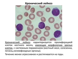 Хронический лейкоз
Хронический лейкоз характеризуется пролиферацией
клеток костного мозга, имеющих морфологию зрелых
клеток, с системным поражением (костный мозг, селезенка,
печень,нелимфоидные органы).
Течение менее агрессивное и растягивается на годы.
 